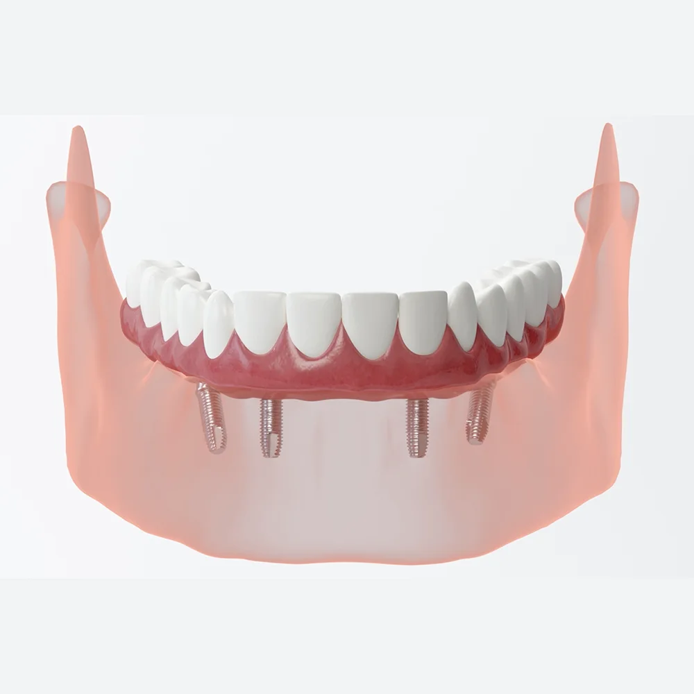 All-on-4 Dental Implants