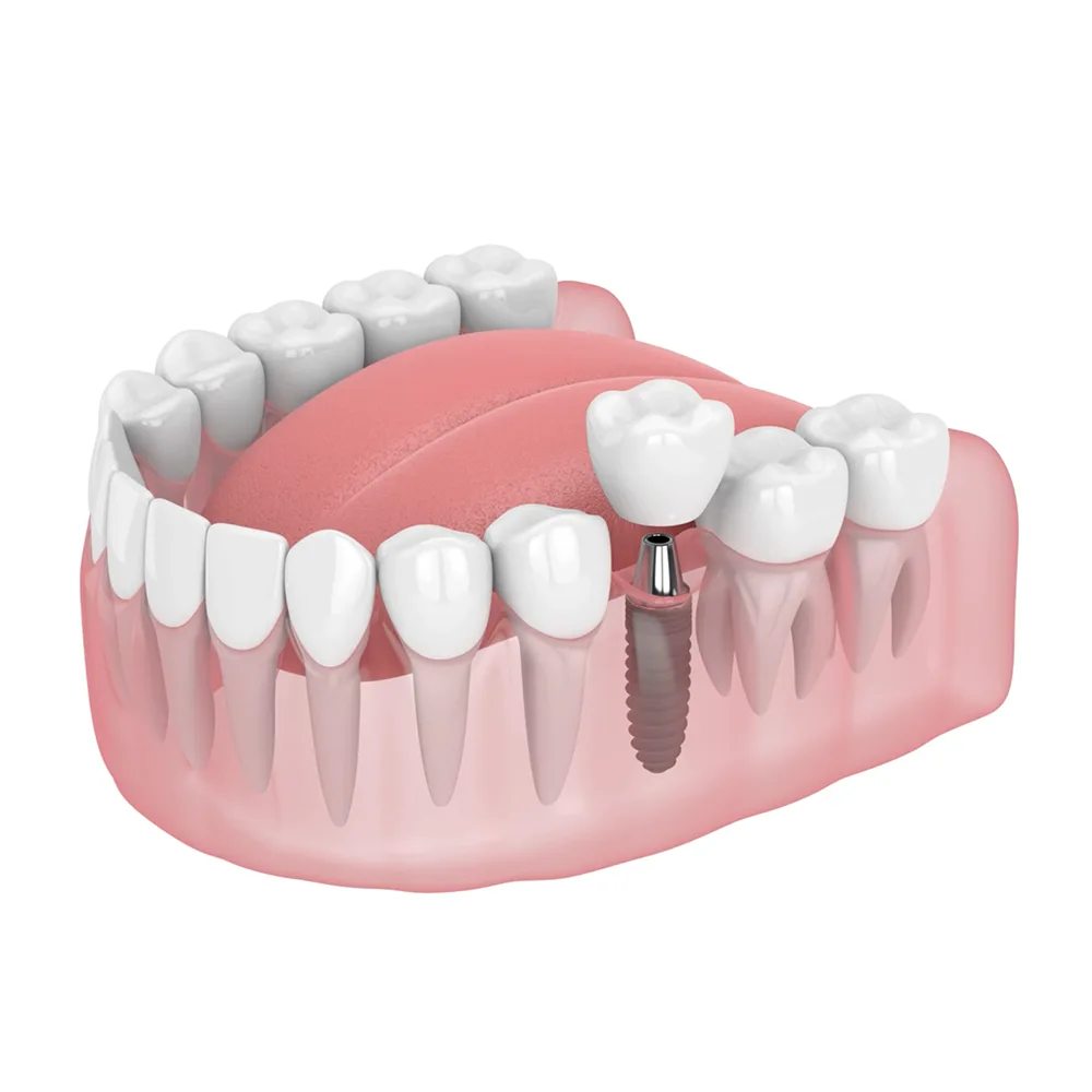 Dental Implants