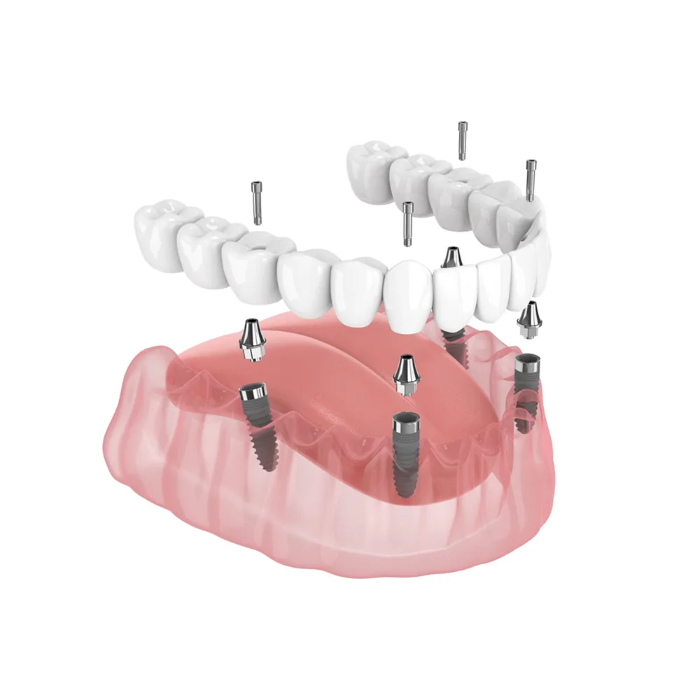 Implant Supported Dentures