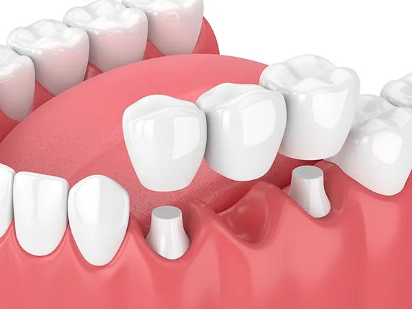 Latest Trends in Dental Ceramics for Crowns and Bridges