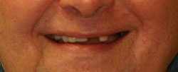 Case 1 before