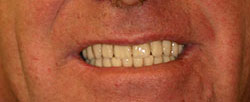 Case 4 after