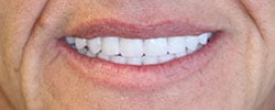 Case 9 after