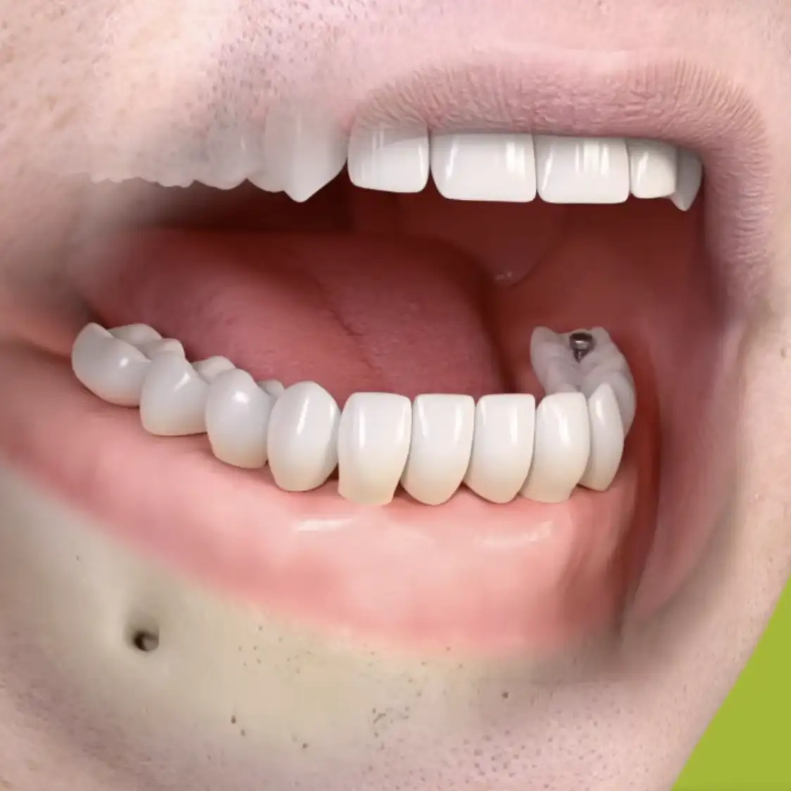 Fixed overdentures thumbnail