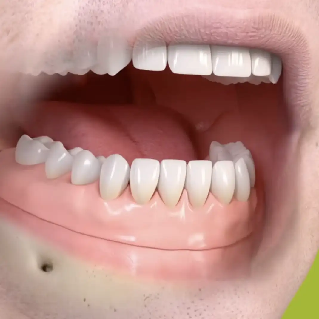 Removable overdentures