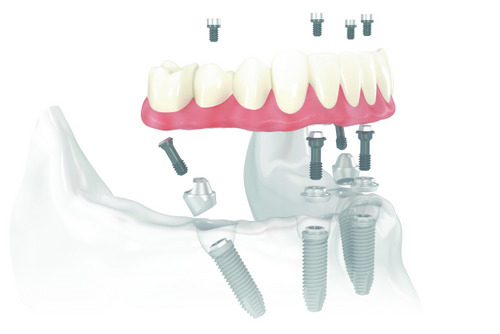 Diagram of the components used in All-on-4 dental implant treatments illustrated by Dental Implant Center at Walnut Creek in Walnut Creek, CA