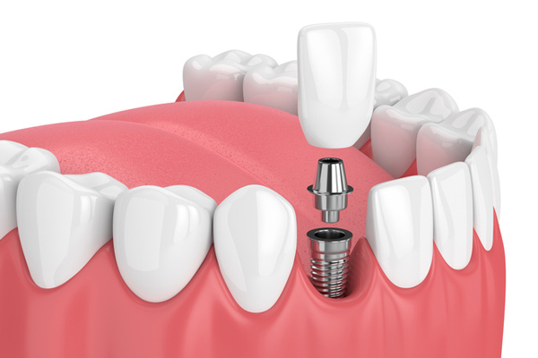 Diagram of a single dental implant from Dental Implant Center at Walnut Creek in Walnut Creek, CA 