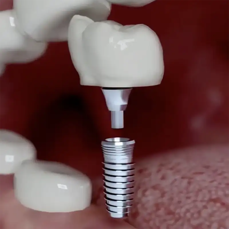 Before and After Dental Implants video thumbnail