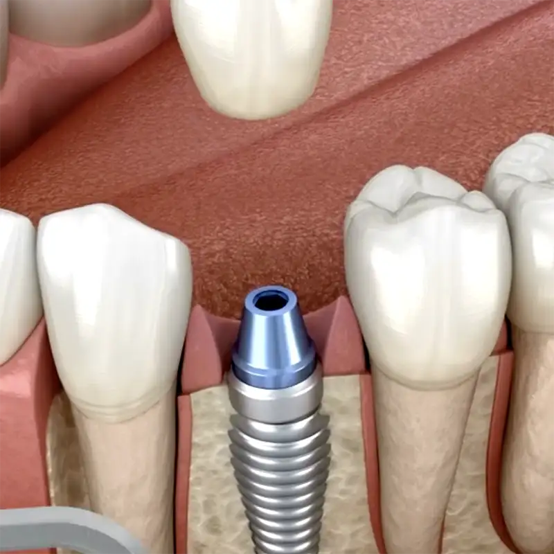 Dental Implant Surgery video thumbnail