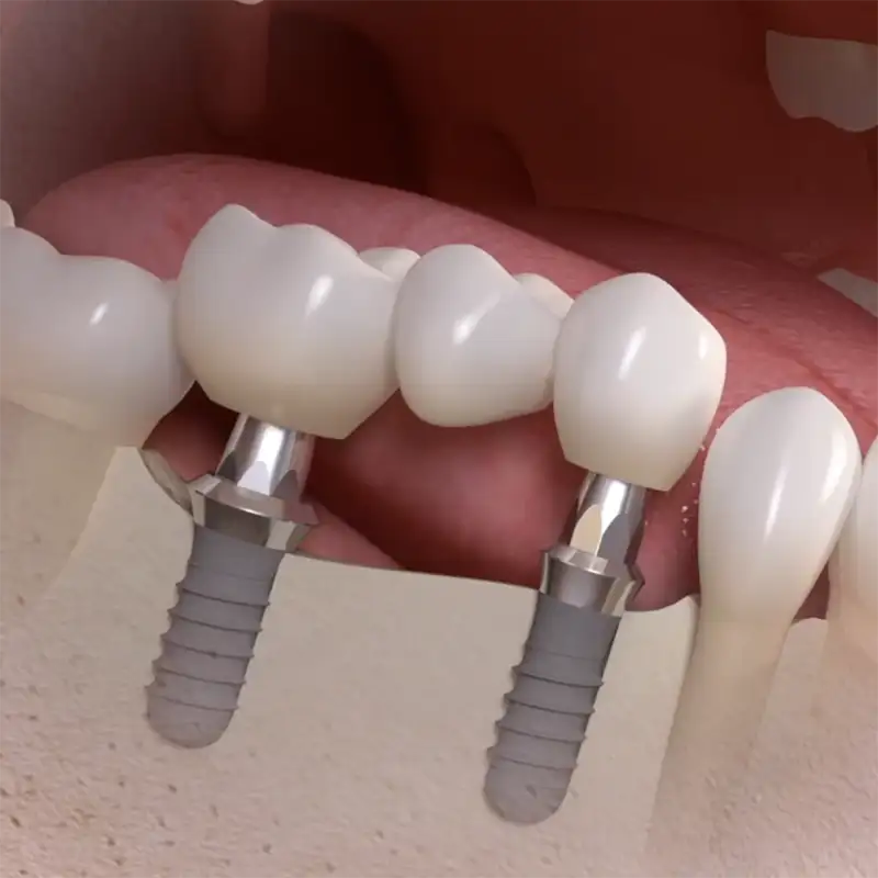 Implant bridge thumbnail