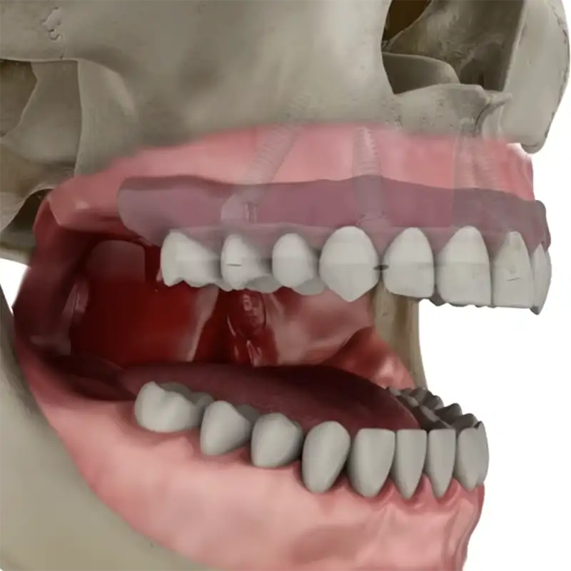 Straumann Pro Arch
