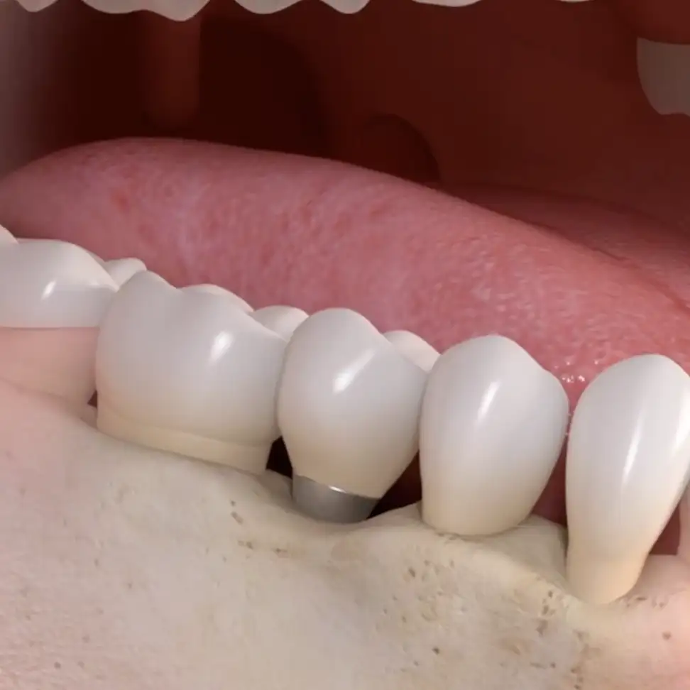 Single tooth replacement