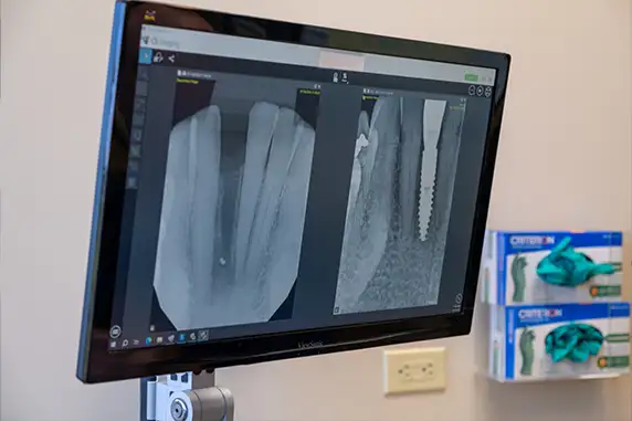 X-ray of single tooth implant before and after in Dental Implant Center at Walnut Creek in Walnut Creek, CA