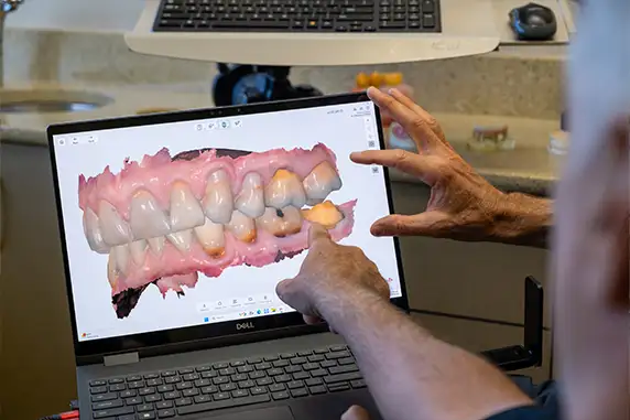 A 3D view of teeth with molars that are decayed.