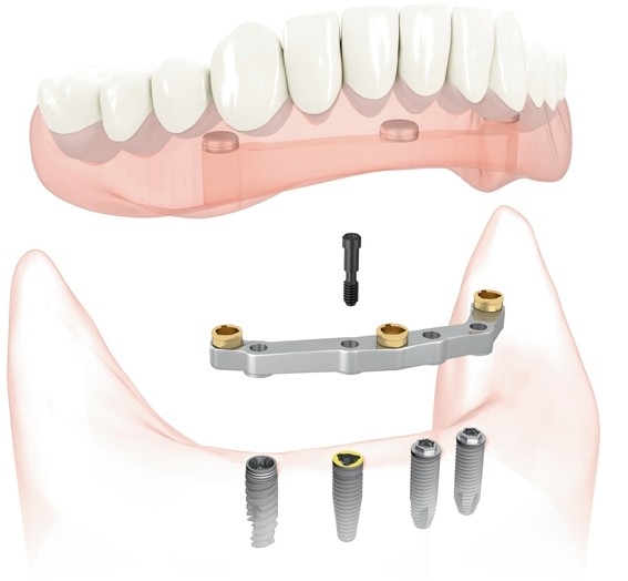 Diagram of how overdentures are fixed to placed dental implants for a secure smile from Dental Implant Center at Walnut Creek in Walnut Creek, CA