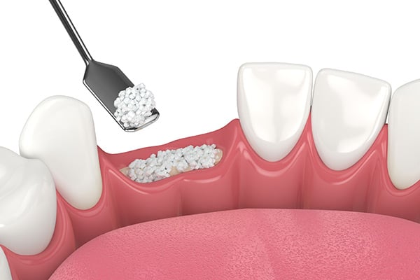 Rebuilding Lost Bone and Gum Tissues for Dental Restorations
