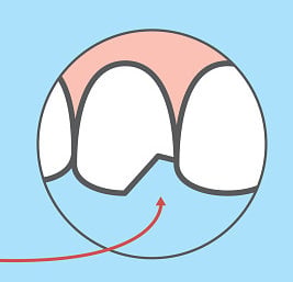 Important Things To Do When A Tooth Is Chipped