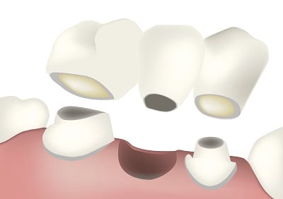 What if my Dental Bridge is Loose Should I Get it Fixed?