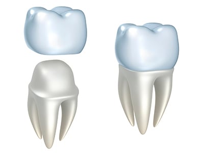 Factors That Affect The Life Of Your Crowns