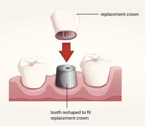 What Makes Gold Ideal For Dental Crowns?
