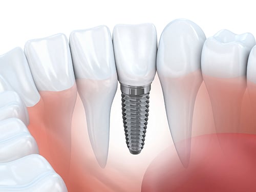 Who Should Not Get Dental Implants?