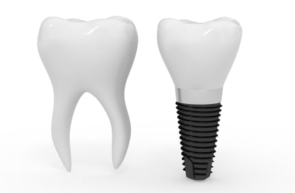 The Benefits of Dental Implants