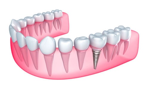 5 Facts About Prosthodontics