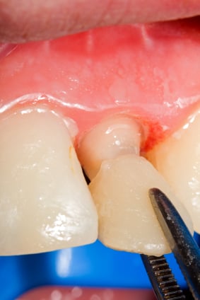 Is Using Your Teeth Roughly Likely to Chip Your Veneers?