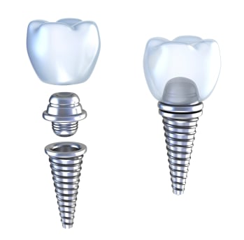 Should You Do Half Implants and Half Dentures?