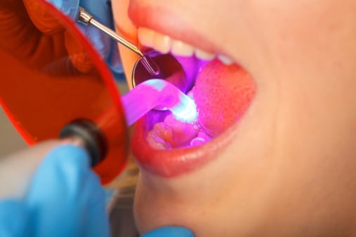 How Dental Bonding Can Fix Minor Issues with Your Smile