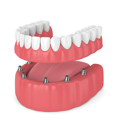 Advantages of prosthesis procedures