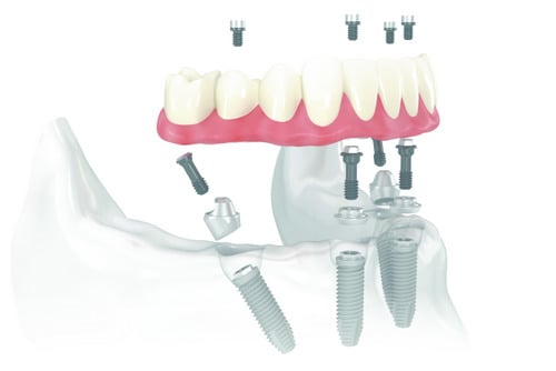 Why is the All-on-4 Treatment Becoming a Popular Choice?