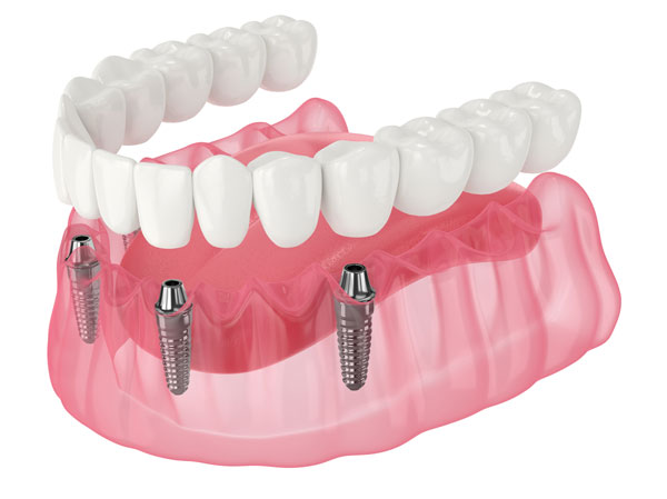 Full Arch Dental Implants Vs. Dentures