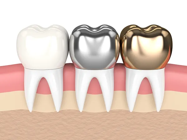 What Are Procera Crowns?