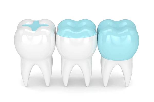 How Long Do Dental Onlays Last?