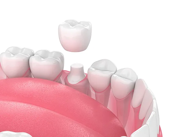 Purpose of a Dental Crown Over a Tooth Following a Root Canal