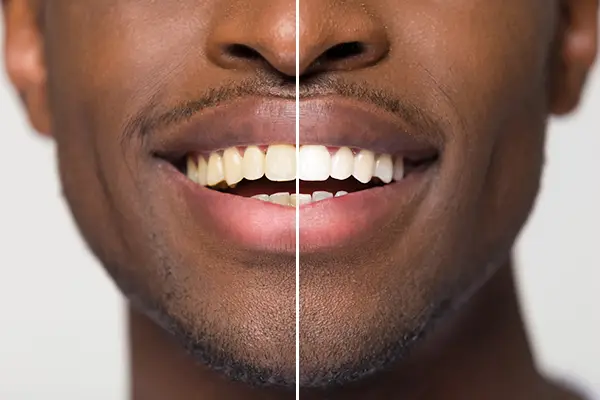 What Is Pap and Is It Safe For Whitening Procedures