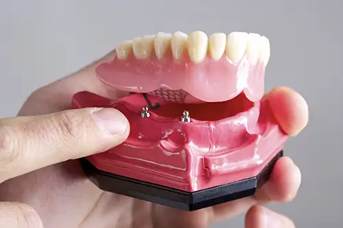 Caring for Implant Supported Dentures 101
