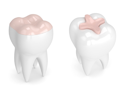 Amalgams in prosthodontics