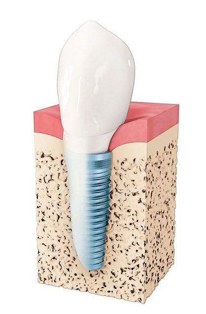 Dental Implants Can Keep You Looking and Feeling Young
