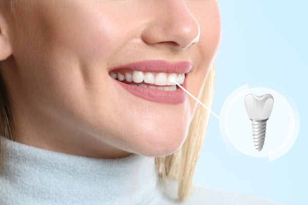 Do You Have to Lose Your Teeth to Get Implants?