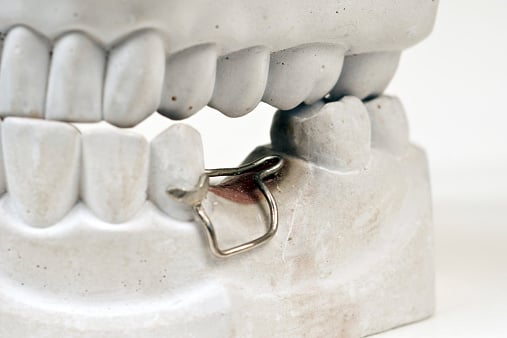 Crowding and Spacing Management in Prosthodontics