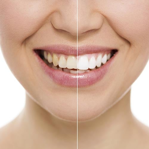 Those Darn Grey Teeth Could Be Due To Tetracycline