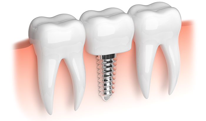 Can't You Just Leave a Gap Where a Tooth Went Missing?