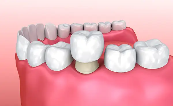 Do You Need to Treat Dental Crowns Differently than Teeth?