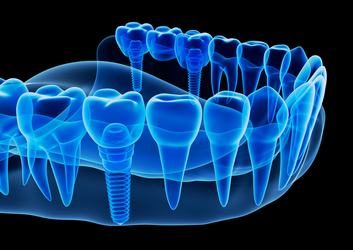 Foods That Can Hurt Your Mouth Following Dental Implant Placement
