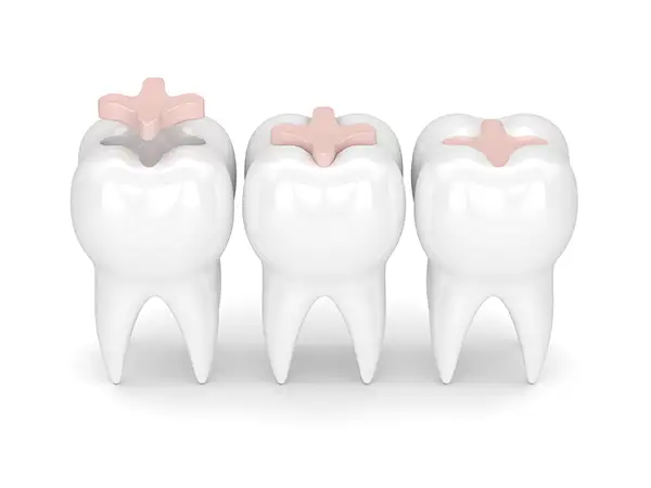 Are Inlays and Onlays Right for Your Teeth?