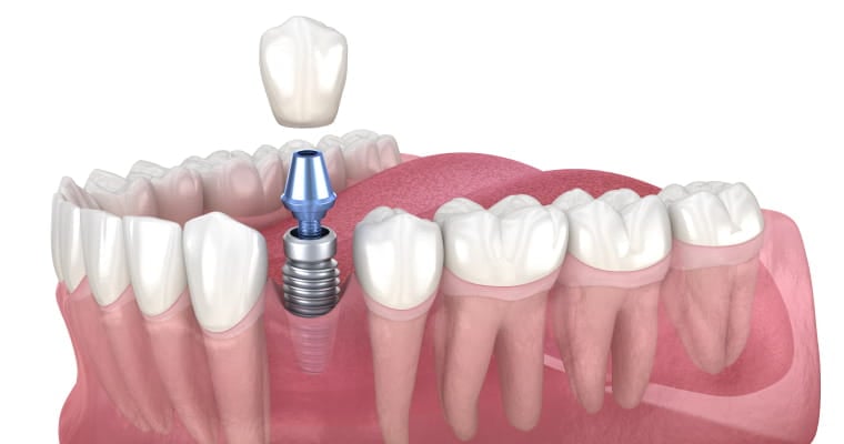 Are Dental Implants Painful? The Truth About Comfort, Healing, and Modern Implant Care in Walnut Creek