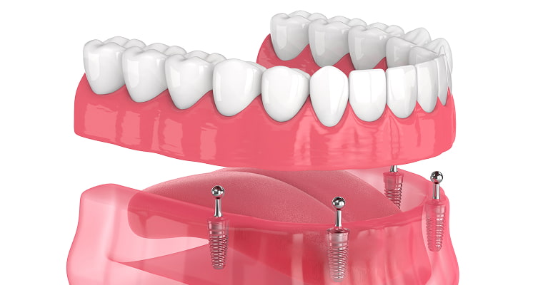 Before and After Dental Implants: Watch a Patient’s Life Change