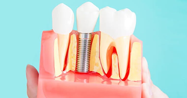 Photo of a dental implant model